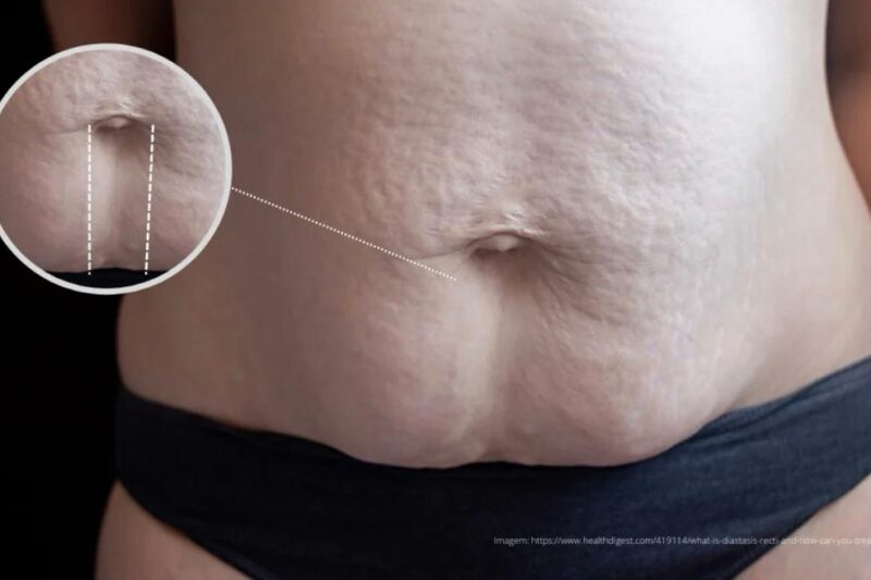 Diástase Abdominal: entenda as causas, complicações e novas soluções para uma vida com mais conforto